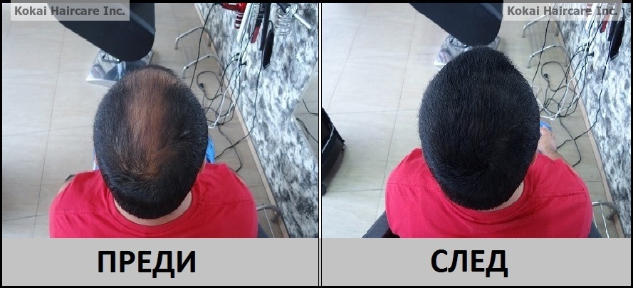 Kokai Hair Loss